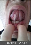 Ader an der Unterseite der Zunge - Problem